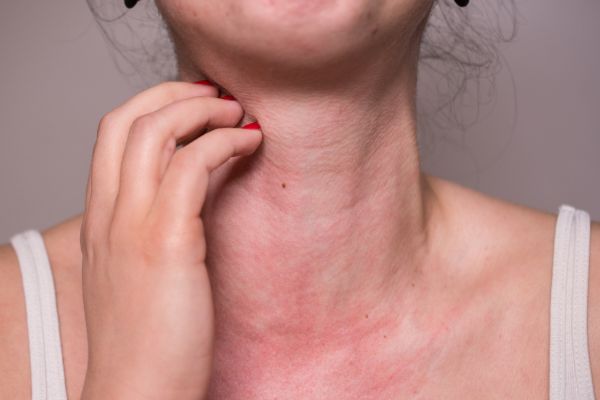 alergias alimentarias